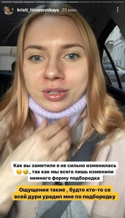 «Будто кто-то ударил по подбородку» — Тимановская рассказала, зачем изменила контур лица и к чему это привело