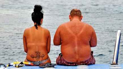 Чем помазать солнечный ожог, если под рукой нет пантенола? Только не сметаной!