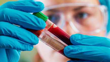 В Витебске назвали цену «доступного» теста на рак, который обещали белорусам