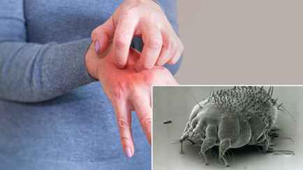 3 признака, что на вашей коже живут эти существа. Когда белорусам нужно немедленно идти в больницу?