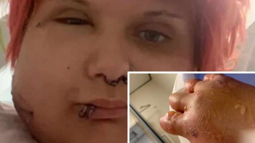 Женщину «раздуло» после прикосновения к растению. В какие заросли белорусам лучше не забредать?