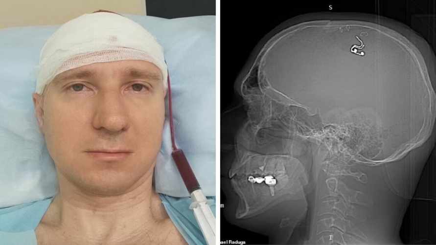 Россиян просверлил себе череп дрелью, чтобы вживить чип. Что с ним теперь?