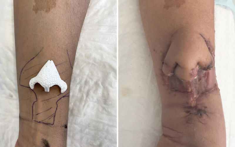 Хирурги пришили напечатанный на 3D-принтере нос к руке пациентки / Фото: CHU de Toulouse