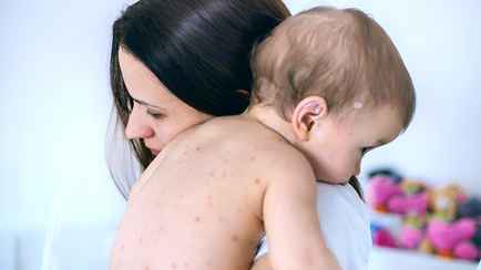 Минздрав зафиксировал подъем заболеваемости корью в Беларуси. Где «развивается эпидемиологическая ситуация»?