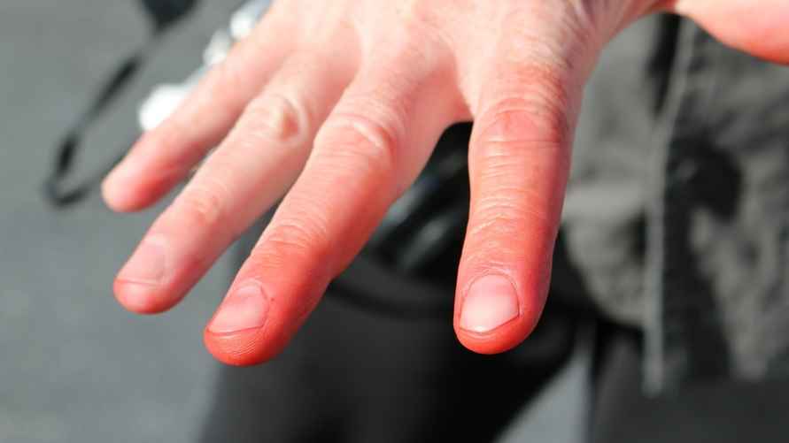 Так может выглядеть обморожение пальцев