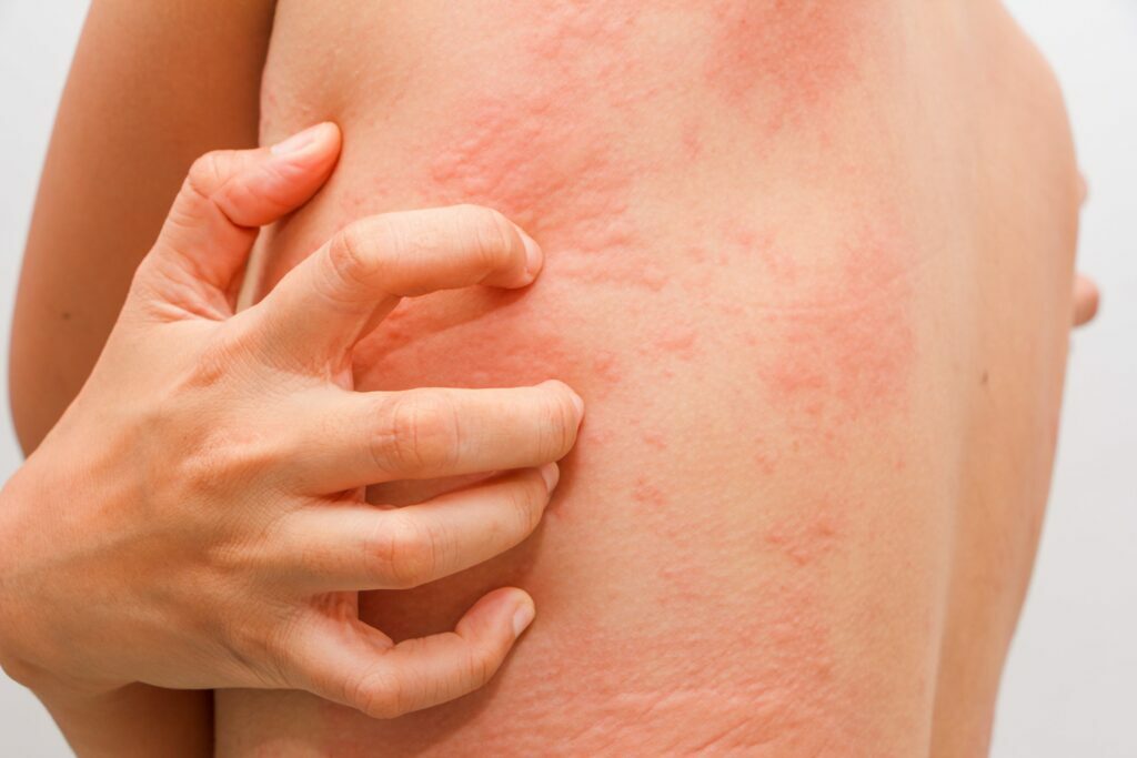 Эти 6 симптомов зимой указывают на неприятное заболевание. Как отличить аллергию на холод от обморожения?