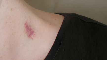 Как избавиться от засоса? Сделайте так — и след исчезнет в 5 раз быстрее чем обычно