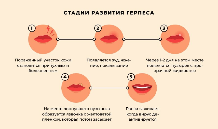 Как быстро избавиться от герпеса? Вот 5 народных рецептов, которые действительно работают