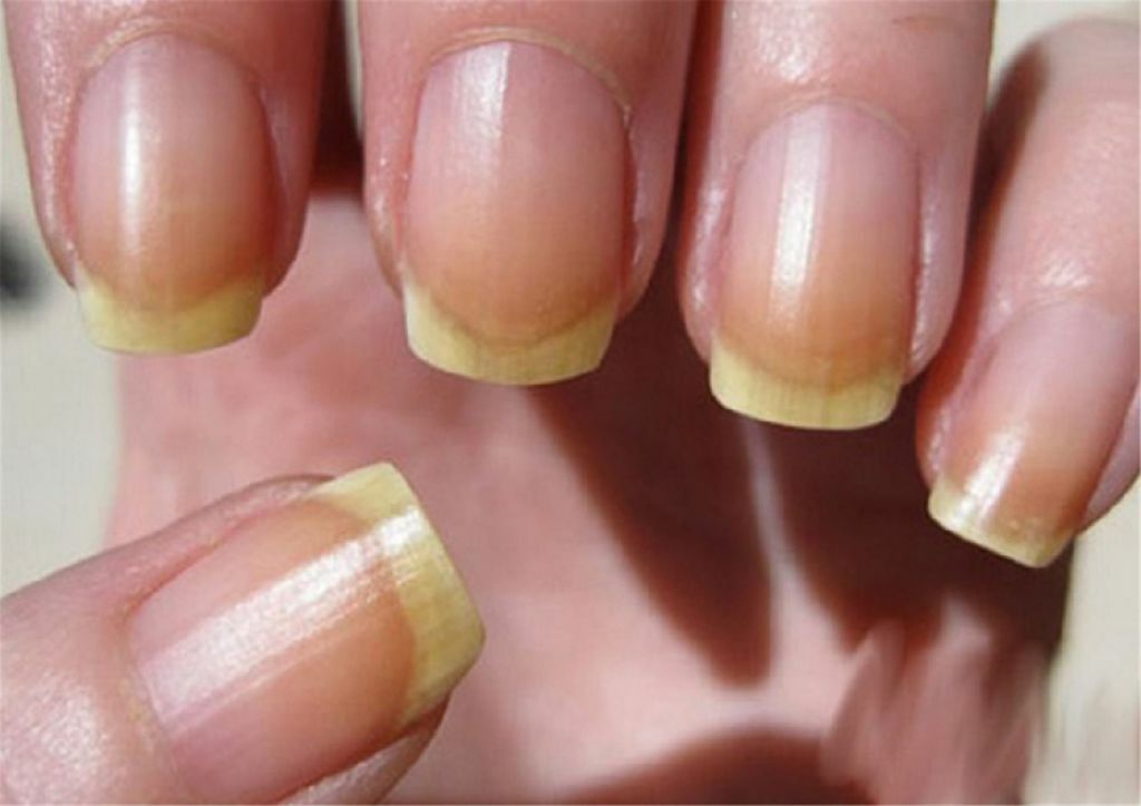 Этот признак на ногтях может предупредить об опасных болезнях. Когда лучше сходить к врачу?