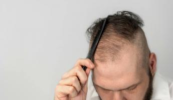 Какие напитки способствуют выпадению волос у мужчин?  Китайские учёные поделились новым исследованием