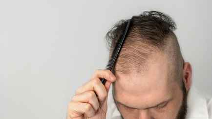 Какие напитки способствуют выпадению волос у мужчин?  Китайские учёные поделились новым исследованием