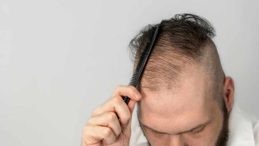 Какие напитки способствуют выпадению волос у мужчин? Китайские учёные поделились новым исследованием