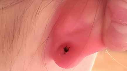 Врачи назвали необычные места на теле, куда впиваются клещи. Что еще проверять, кроме мочки уха и пупка?