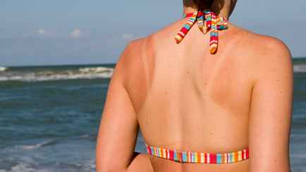 Как избавиться от неудачного загара? Сок этого растения поможет вернуть коже естественный цвет