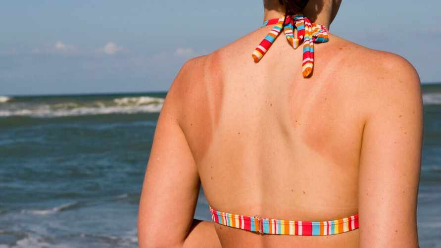 Как избавиться от неудачного загара? Сок этого растения поможет вернуть коже естественный цвет