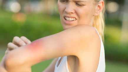 После укуса комара появился странный след? Вот почему нужно немедленно к врачу