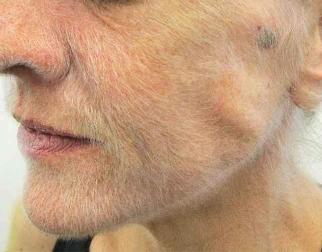 Ланугинозный гипертрихоз