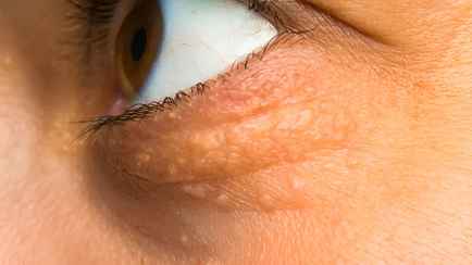 Заметили на веках или в уголках глаз едва заметные «узелки»? Это признак серьезной проблемы в организме