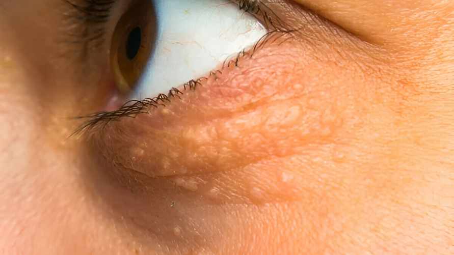 Заметили на веках или в уголках глаз едва заметные "узелки"? Это признак серьезной проблемы в организме