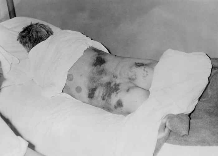 Изолированный пациент с диагнозом Конго-Крымская геморрагическая лихорадка (ККГЛ).