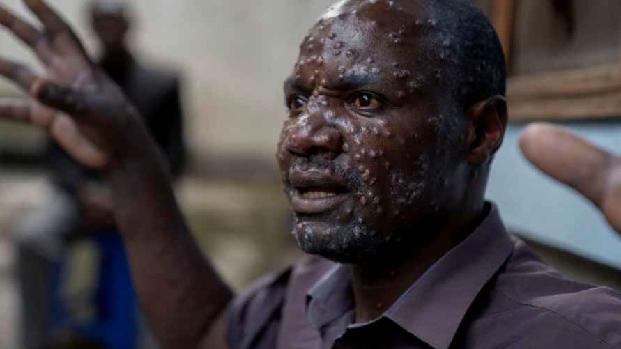 Оспа вызывает болезненные поражения и быстро распространяется в Африке Фото: Arlette Bashizi/REUTERS