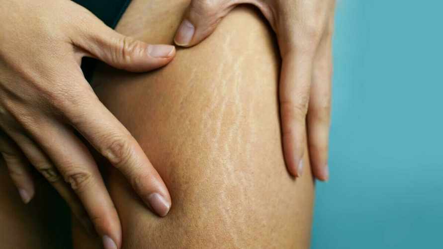 Что делать с растяжками на коже? Этот домашний скраб уменьшит их видимость