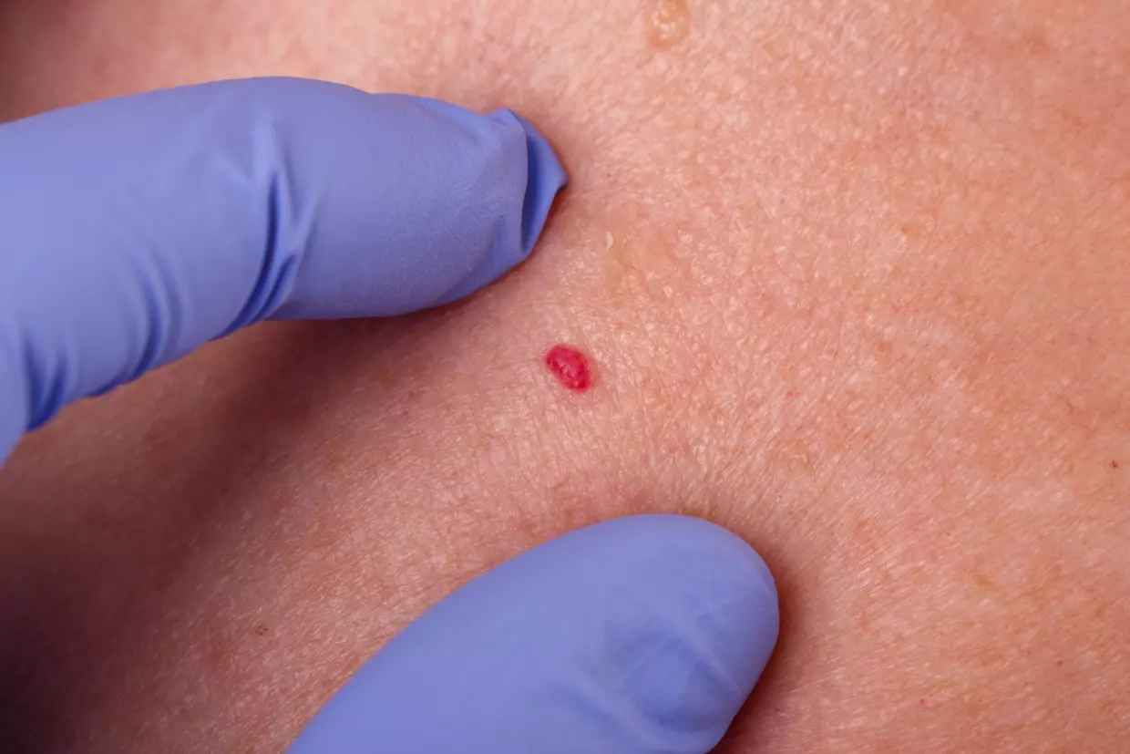 На коже появились такие рубиновые пятна? Вот о чем сигнализирует ваш организм