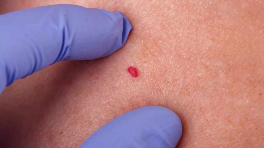 На коже появились такие рубиновые пятна? Вот о чем сигнализирует ваш организм