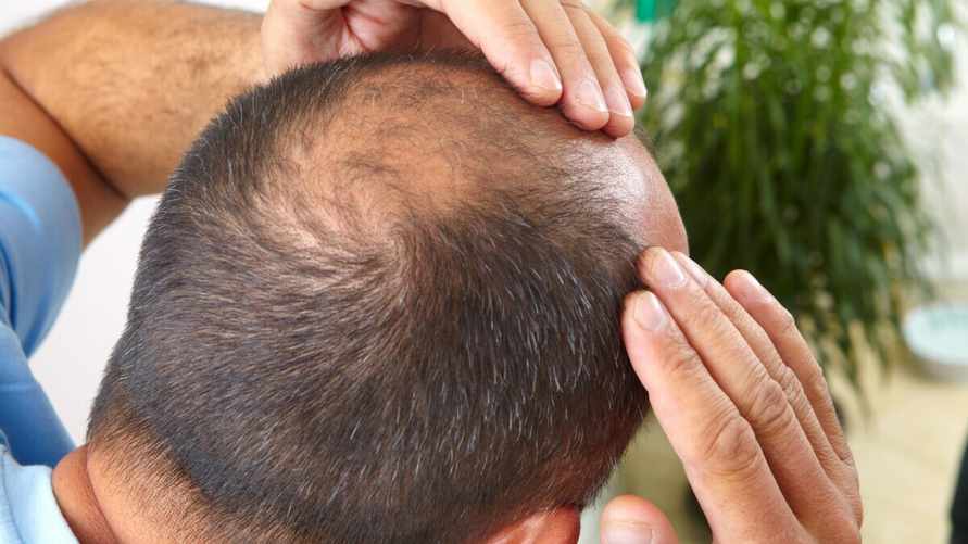 Ученые раскрыли распространенную привычку, которая может привести к облысению. Многим это не понравится