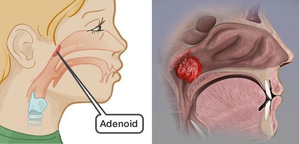 Когда лучше удалять аденоиды — летом или зимой? Белорусский лор объяснила