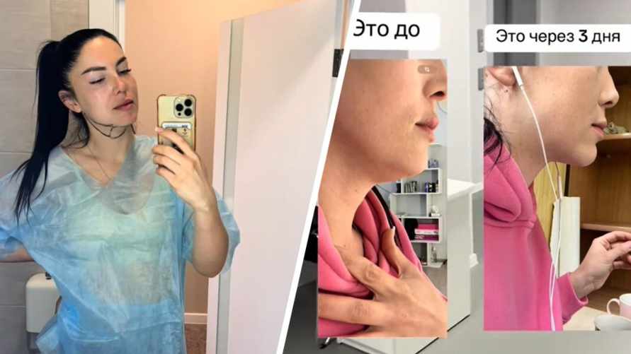 "Достали полстакана жира" - Минчанка сделала липосакцию 2-го подбородка. Сколько отдала?