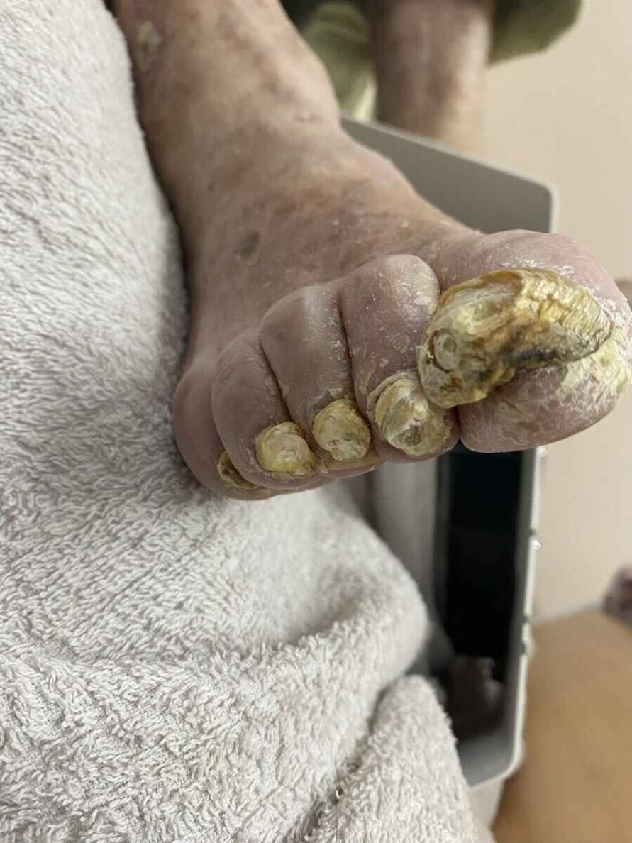 Обработка грифозных ногтей, фото: Татьяны Стасюкевич