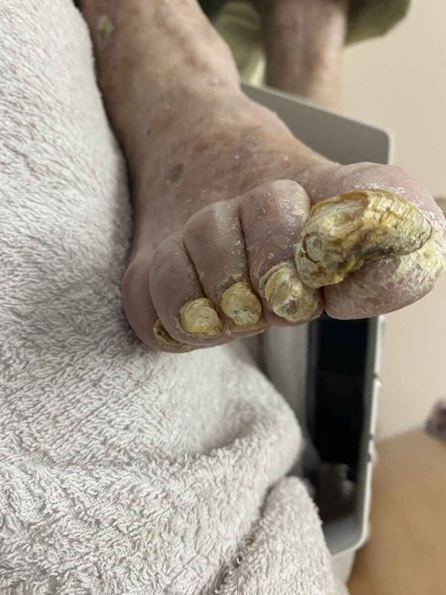 Обработка грифозных ногтей, фото: Татьяны Стасюкевич