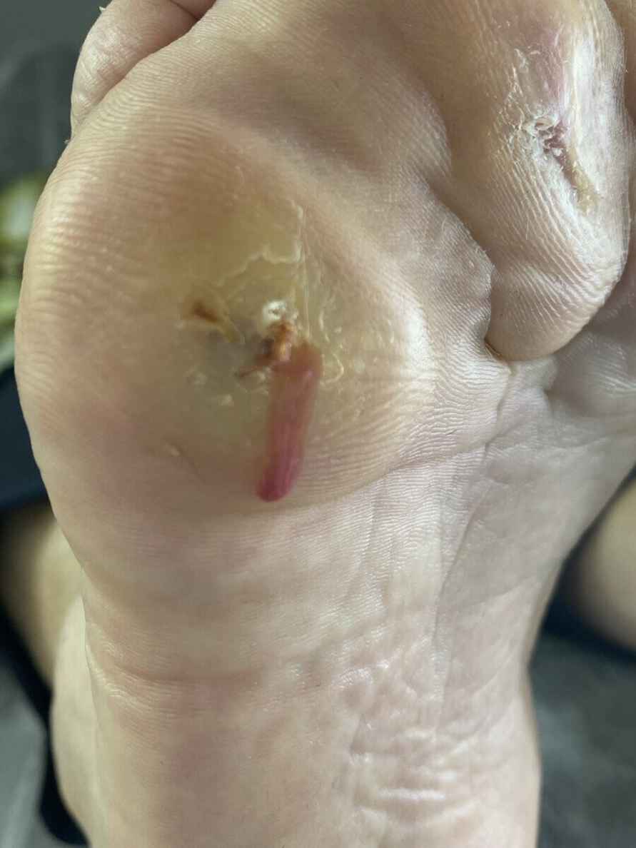 Подолог призвала белорусов не покупать этот популярный мозольный пластырь. Почему раздражает и травмирует?