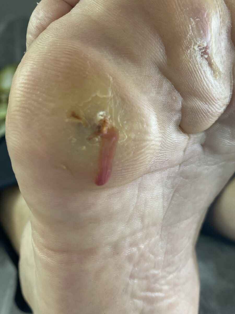 Подолог призвала белорусов не покупать этот популярный мозольный пластырь. Почему раздражает и травмирует?