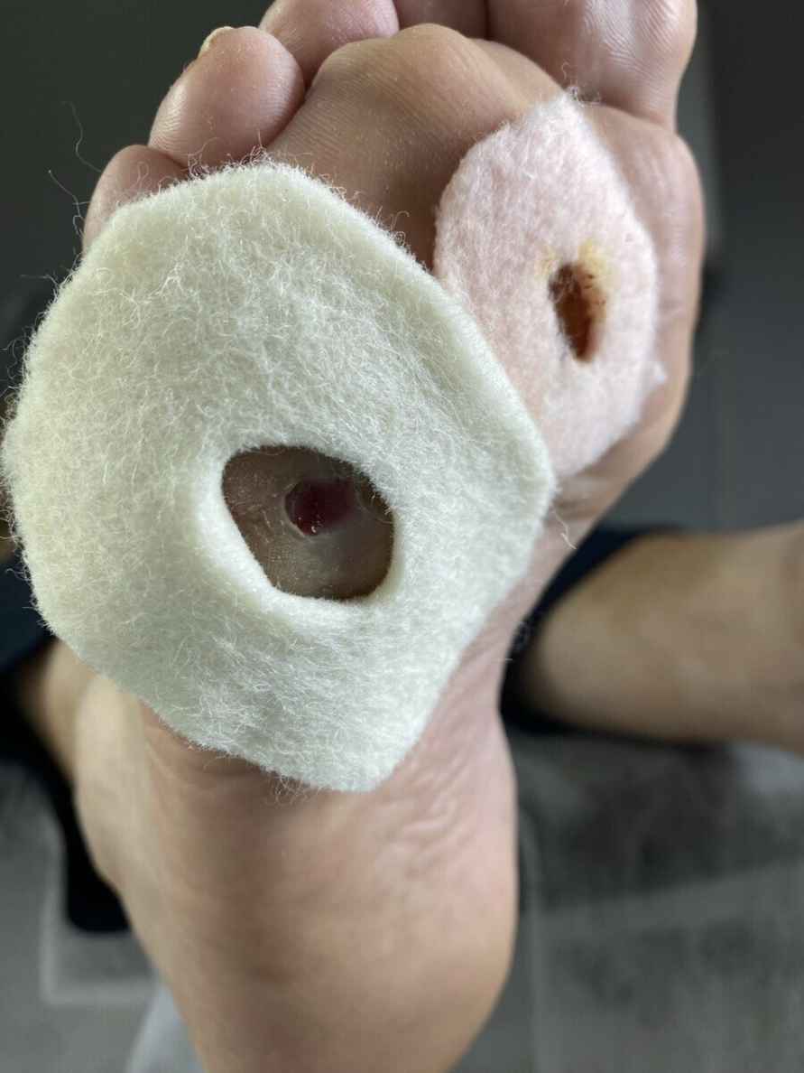 Обработка мозолей, фото: Татьяны Стасюкевич