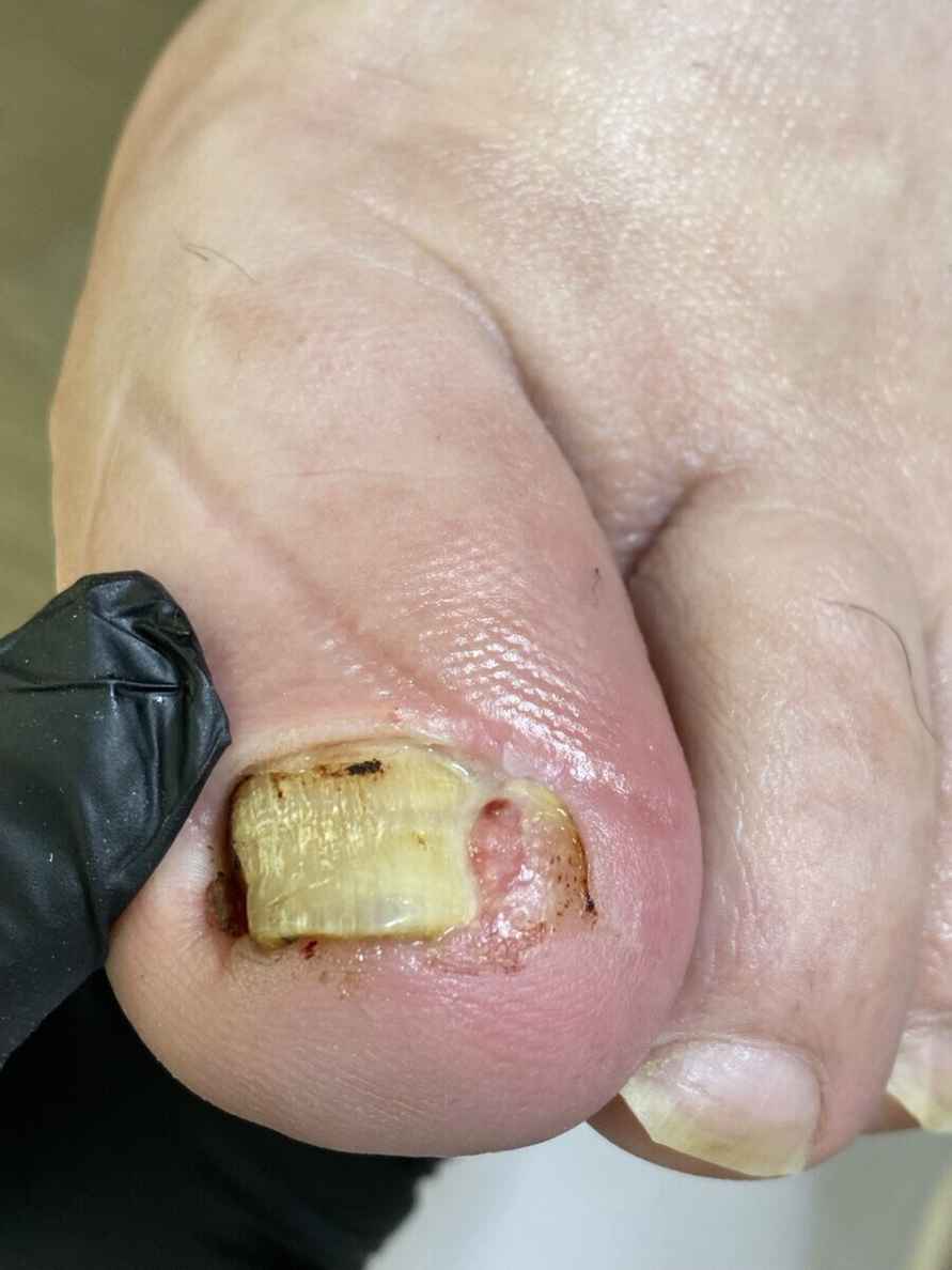 Работа с вросшим ногтем, фото: Татьяны Стасюкевич