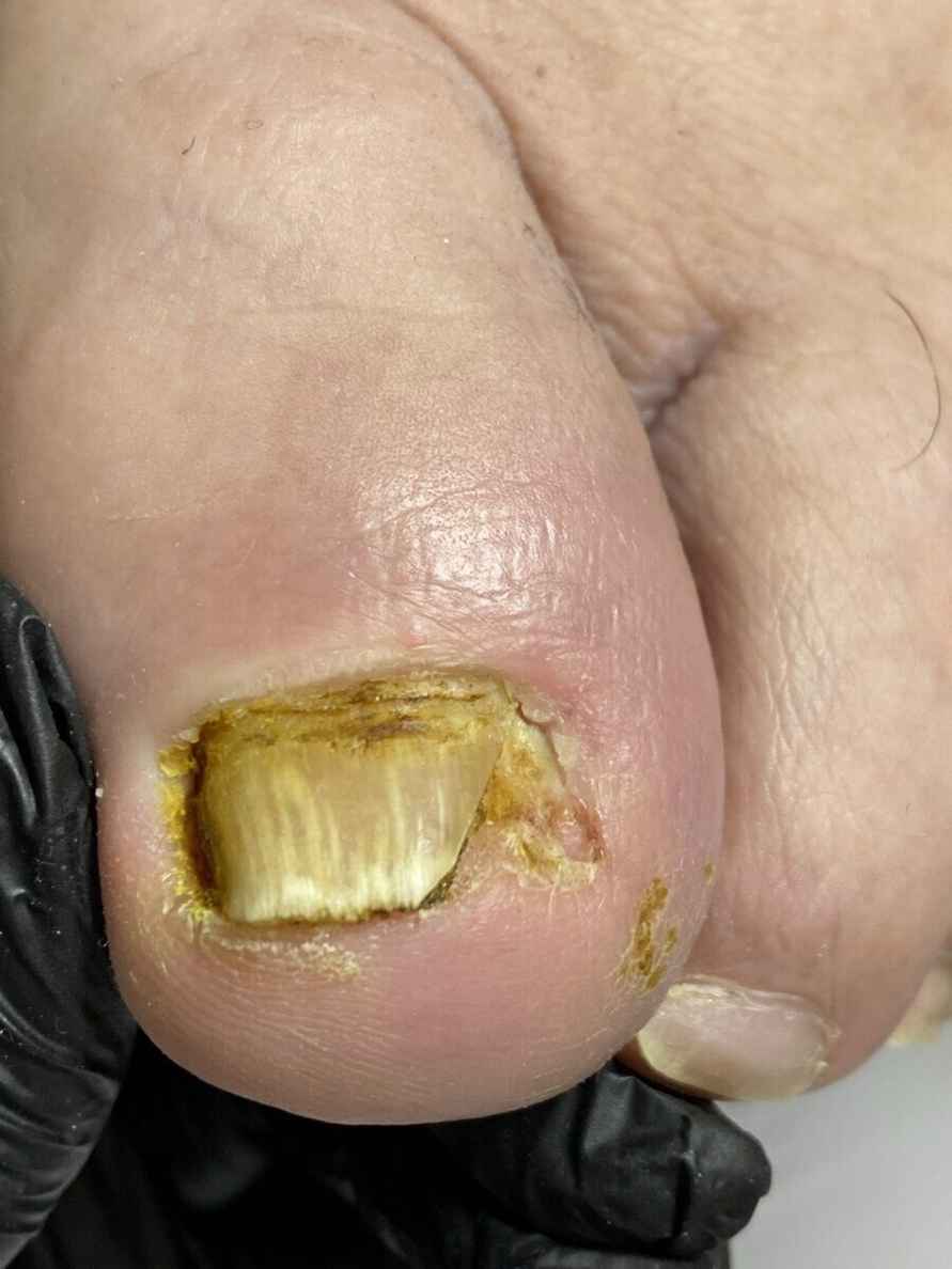 Подолог призвала белорусов не покупать этот популярный мозольный пластырь. Почему раздражает и травмирует?