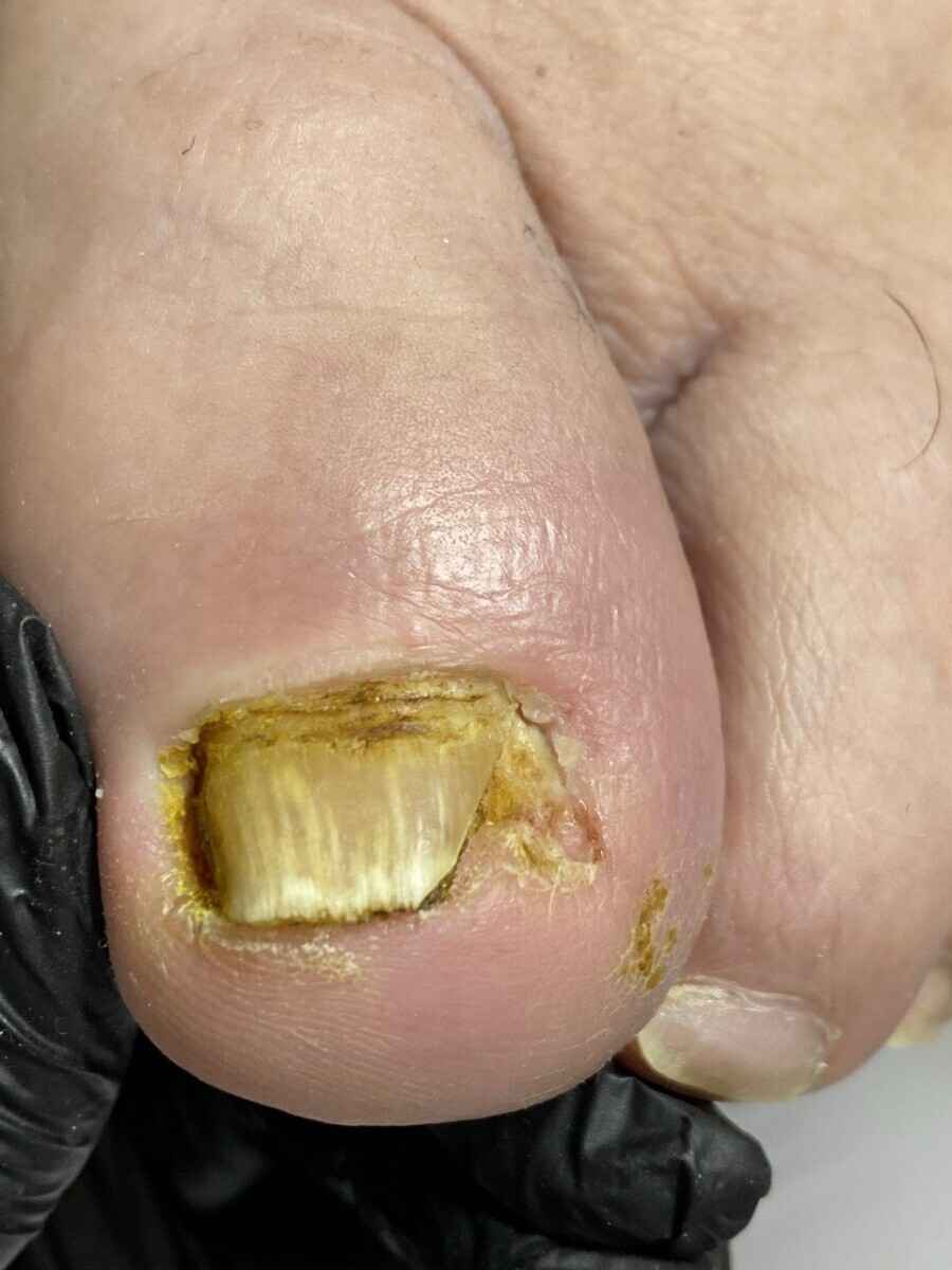 Подолог призвала белорусов не покупать этот популярный мозольный пластырь. Почему раздражает и травмирует?