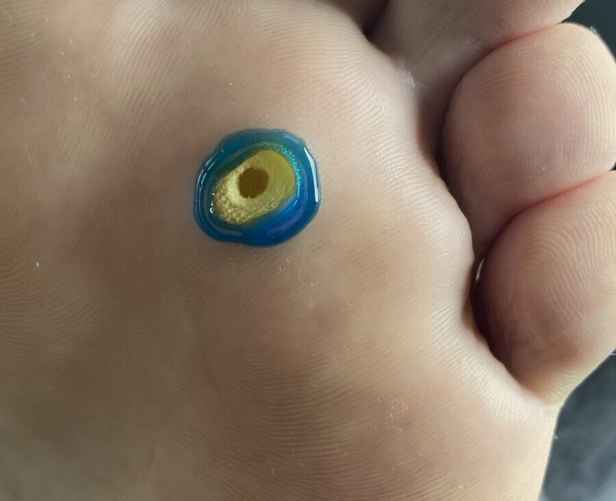 Безболезненная обработка бородавки. Фото: из личного архива Татьяны Стасюкевич