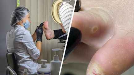 Подолог призвала белорусов не покупать этот популярный мозольный пластырь. Почему «раздражает и травмирует»?