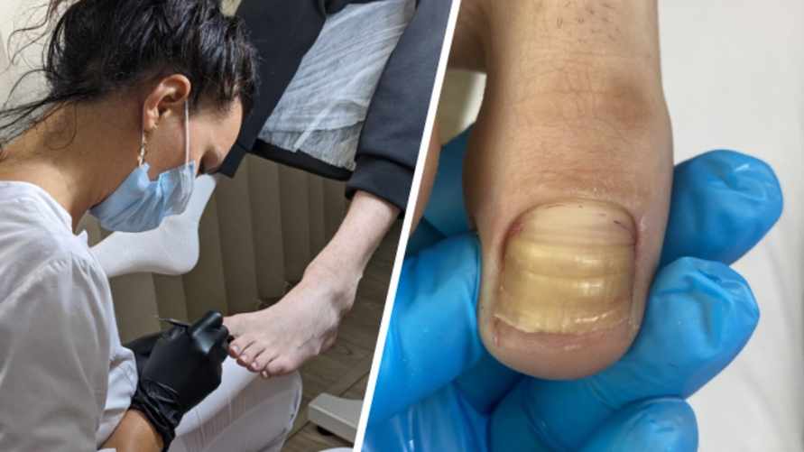 Подолог назвала незаменимую вещь в бассейне и бане, чтобы не заразиться грибком. Что еще поможет?