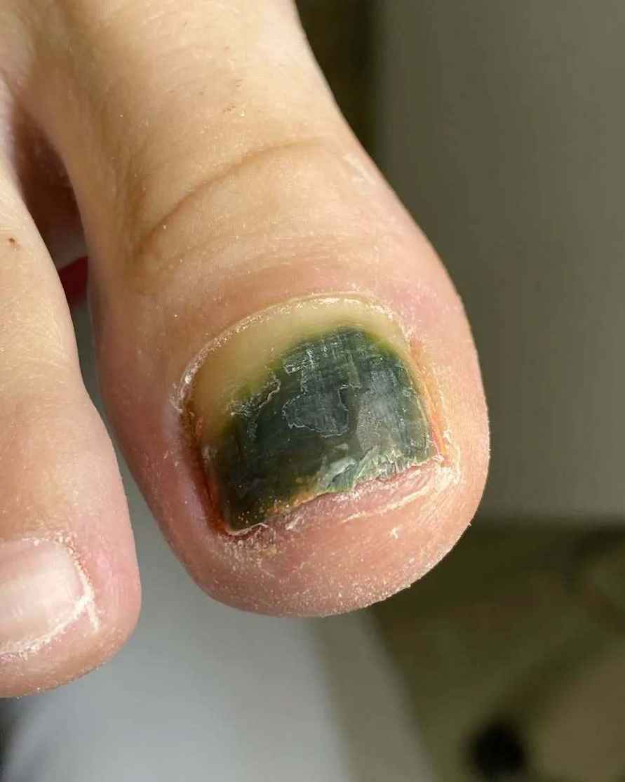 Почему весной и летом гель-лак на ногах может быть опасен? Подолог показала печальные последствия