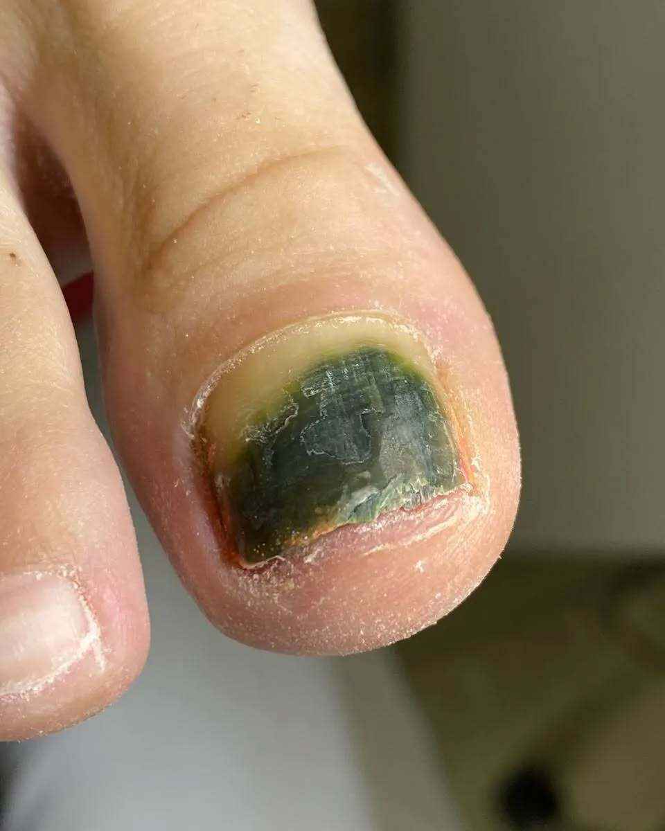 Почему весной и летом гель-лак на ногах может быть опасен? Подолог показала печальные последствия