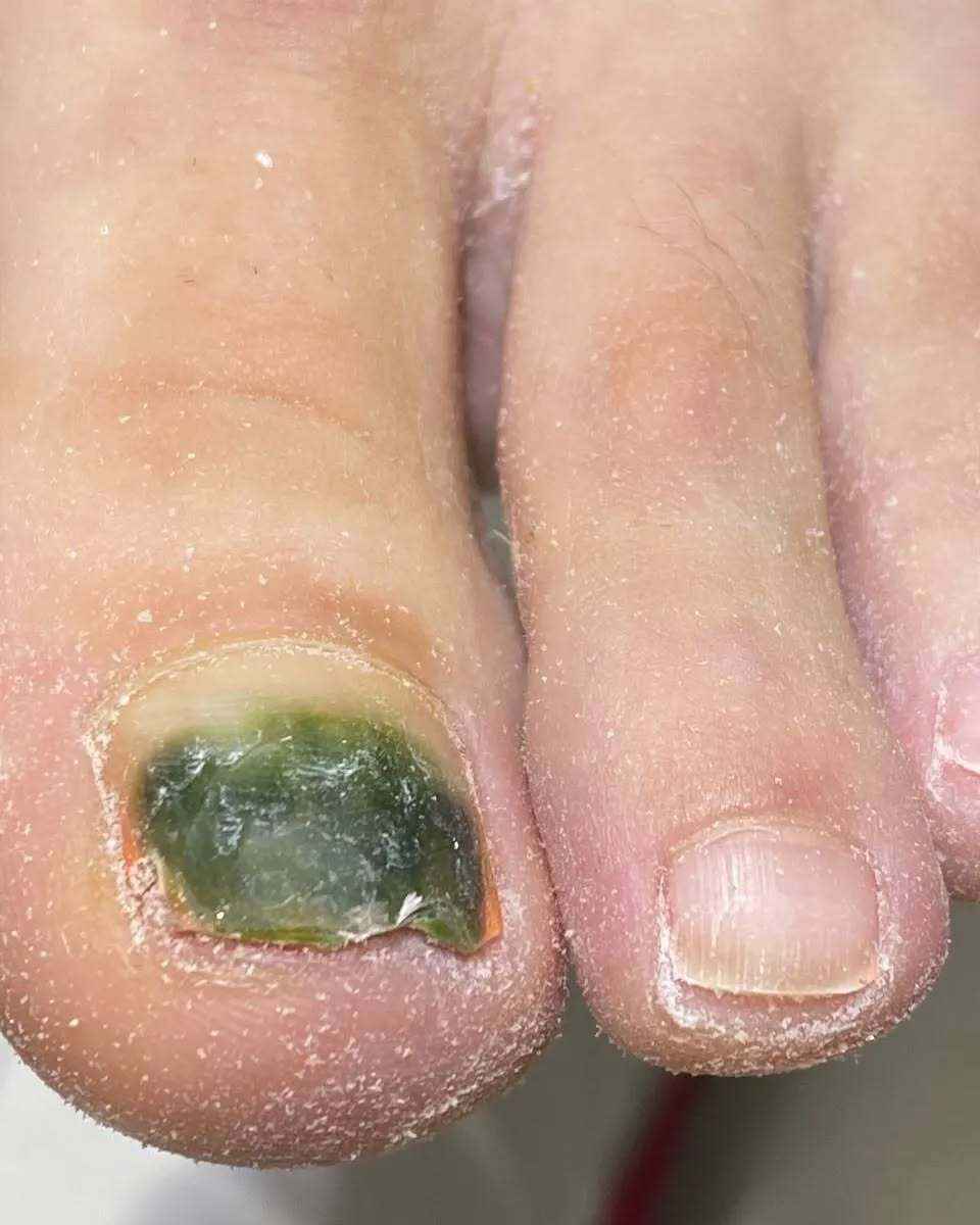 Почему весной и летом гель-лак на ногах может быть опасен? Подолог показала печальные последствия