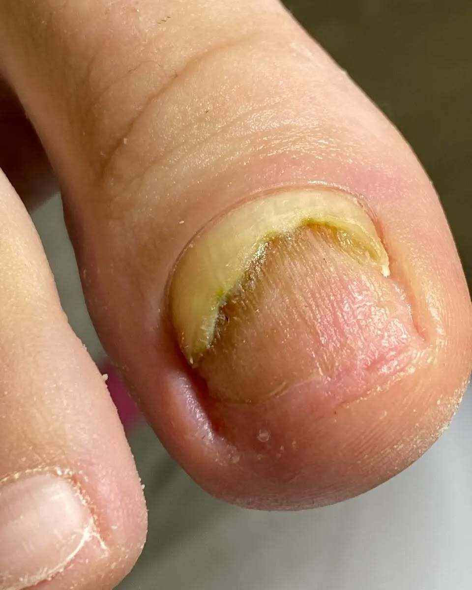 Почему весной и летом гель-лак на ногах может быть опасен? Подолог показала печальные последствия