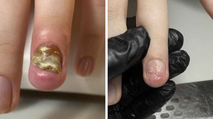 После неудачного маникюра и двух хирургических вмешательств, подолог работала с проблемой больше года, фото: Татьяны Стасюкевич