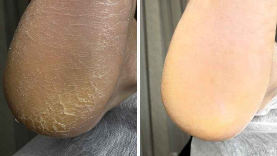 Обработка пяток, фото: Татьяны Стасюкевич