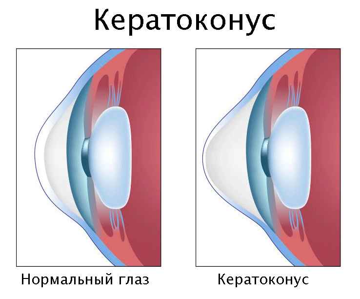 Офтальмологи призвали отказаться от привычки, ухудшающей зрение. Чем заменить?