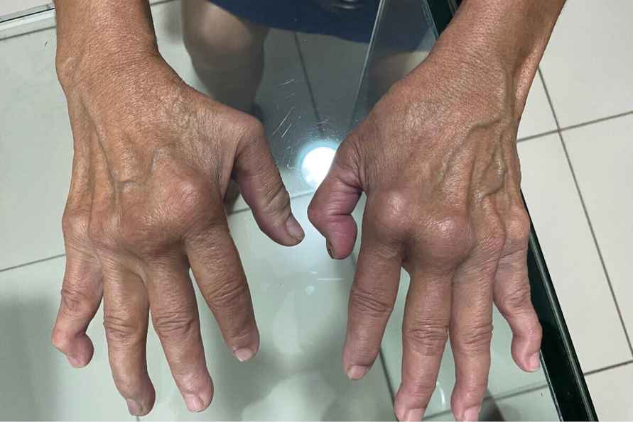 В Китае уже более 7 тыс. человек заразились новым вирусом Чикунгунья. Его переносят комары